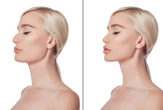 Burun Estetiği (Rinoplasti)