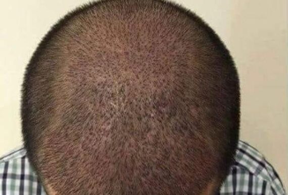 FUE Yöntemi Saç Ekimi