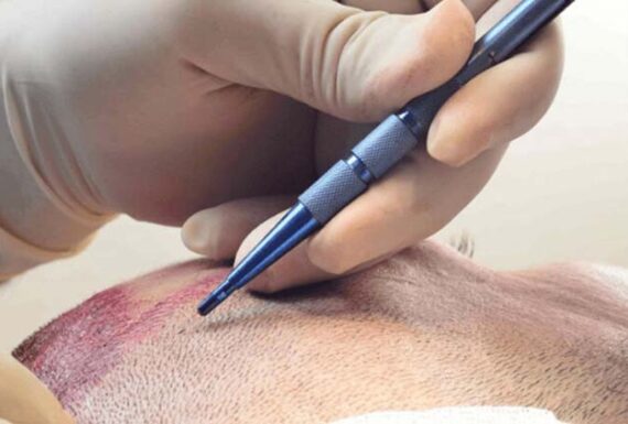 Safir Uç Yöntemi ile Saç Ekimi